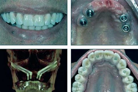 Zygomatic Implants In Turkey : Prices, Types, Procedures And Patients ...