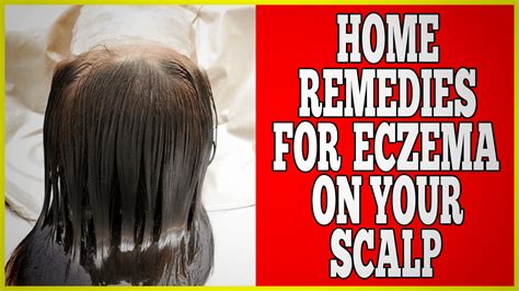 Home Remedies For Eczema On Scalp - Clinton Conley