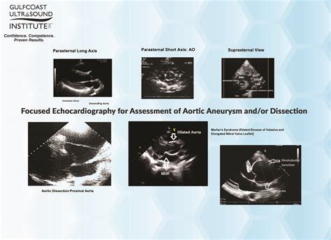 Focused Echocardiography for Assessment of Aortic Aneurysm and/or Dissection - Gulfcoast ...