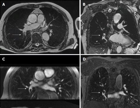 Magnetic resonance angiography for the primary diagnosis of pulmonary ...