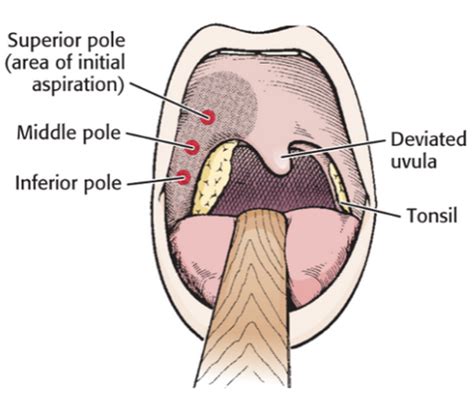 Peritonsilar Abscess Drainage - Guide to YKHC Medical Practices