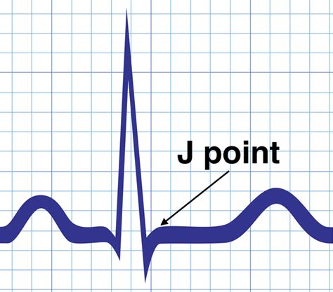 J point - ECG Review | LearntheHeart.com