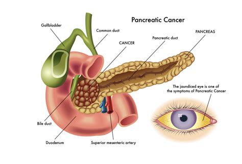 Dr Scott Gerber - A Novel Combination Therapy for Pancreatic Ductal Adenocarcinoma • scientia.global