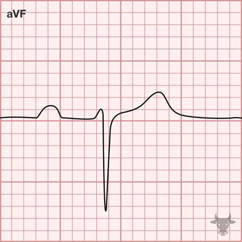 Left Anterior Fascicular Block | ECG Stampede