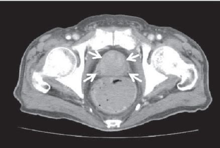 Enlarged Prostate X Ray