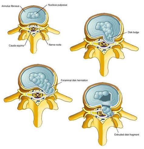 Lumbar Prolapsed Intervertebral Disc (PID) and Sciatica (HNP) Microdiscectomy