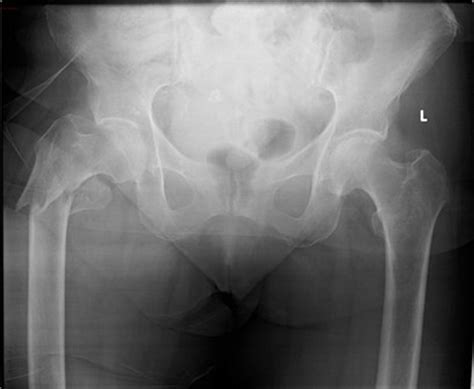 Failure of knee arthroplasty secondary to inadequate technique in ...