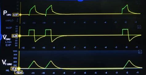 Understanding Ventilator Basics and Ventilator Waveforms | RT