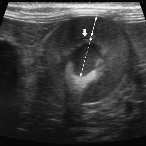 Ultrasound measurement of the renal length, cortical thickness, and... | Download Scientific Diagram