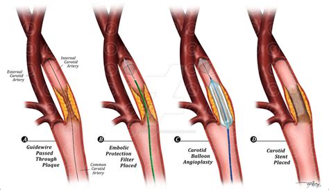 Carotid Angioplasty and Stent by Salvationalizm on DeviantArt