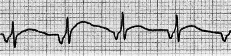 Accelerated Junctional Rhythm (AJR) • LITFL • ECG Library Diagnosis