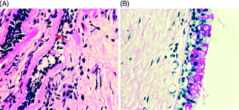 Bronchial biopsy sections from patients with (A) biomass-smoke (BS ...