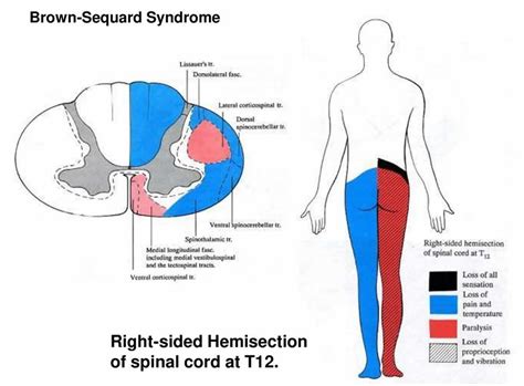 Brown Sequard Syndrome Mayo Clinic Captions More | My XXX Hot Girl