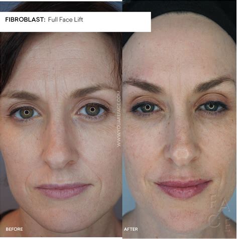 Plasma Fibroblast Skin Tightening with Plasma Pen | Oakland & LA — FACE