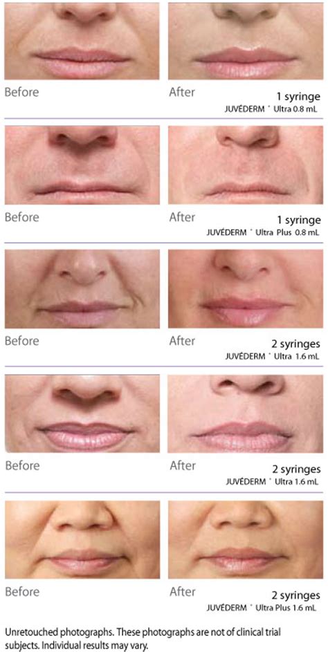 Dermal Fillers Juvederm Ultra Plus XV & Voluma XC - Pearland Med Spa