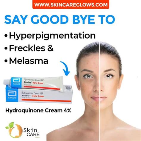 Hydroquinone Cream 4% | Melalite Forte【 Buy Now】 Skin Whitening Gel