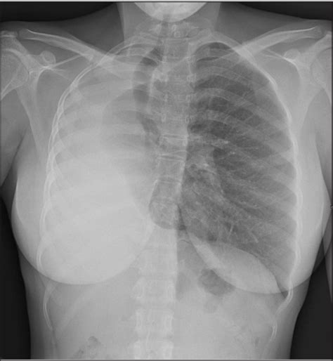 Figure 1 from Primary Pulmonary Hypoplasia | Semantic Scholar