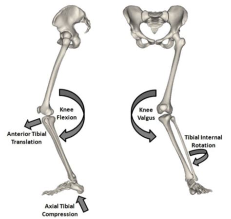 The ACL Injury - ProPhysio+