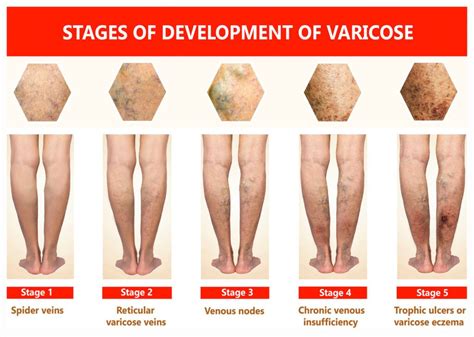 What Is Venous Ulcer Disease? A Doctor's Guide | Vein & Vascular ...