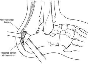 Achilles Tendon Surgery - Dr Greg Sterling