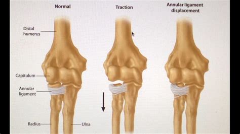 Image result for annular ligament of radius | Subluxation, Elbow, Tennis elbow