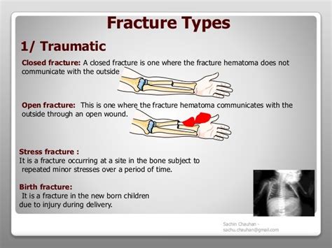 Fracture - Types, complications and management