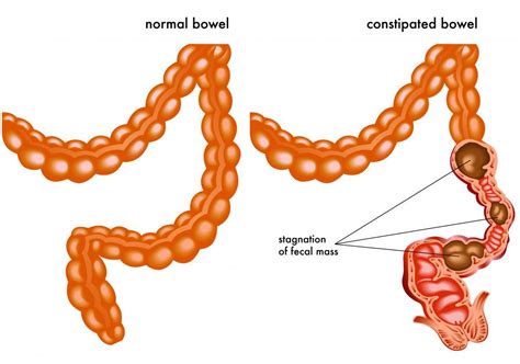 What is a Spastic Colon? (with pictures)