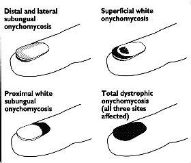 Total Dystrophic Onychomycosis