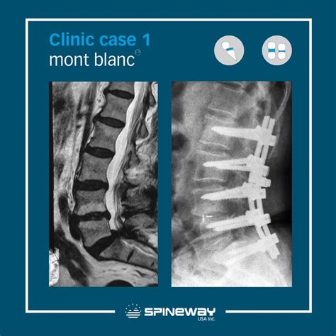 Clinical Case: Before and After. Woman, 65 years old, L4 – L5 disc herniation and ...