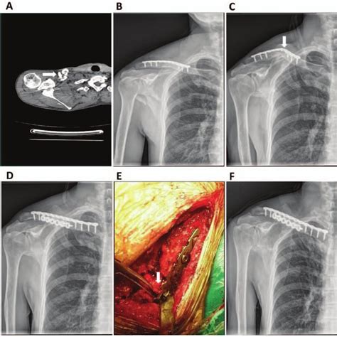 A case with plate breakage and clavicle nonunion after open surgery was... | Download Scientific ...