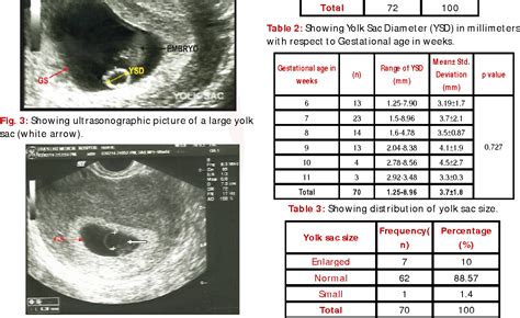 Table 2 from Size of Yolk Sac by Ultrasonography and Its Correlation ...