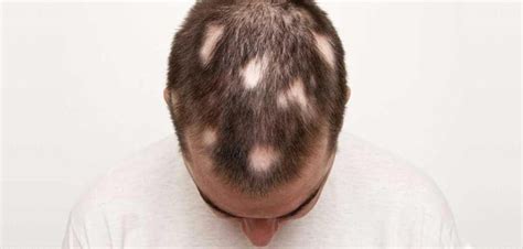 6 Major types of Alopecia with Causes Treatments - RepHair