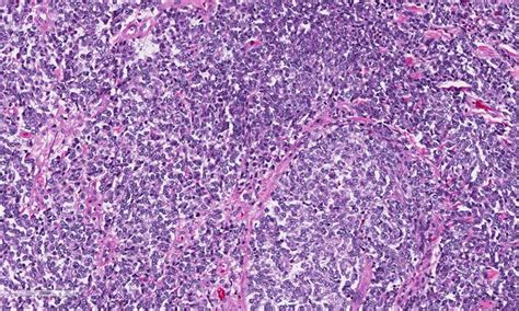 Bone and Soft Tissue: Ewing sarcoma