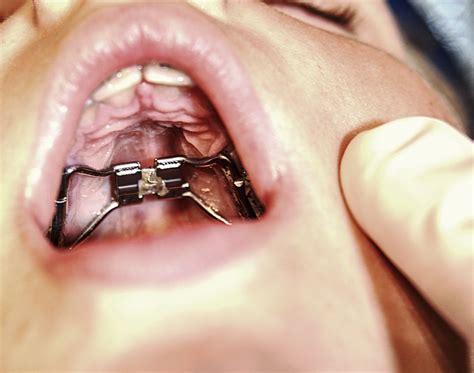 Palatal Expander - Orthodontics by Steve Chapman