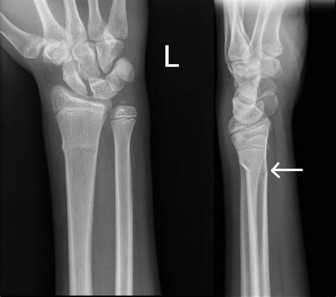 Greenstick Fracture X Ray