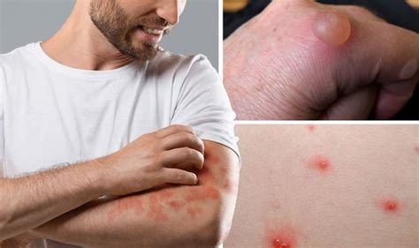 Coronavirus: Chilblain and maculopapular rash are symptoms | Express.co.uk