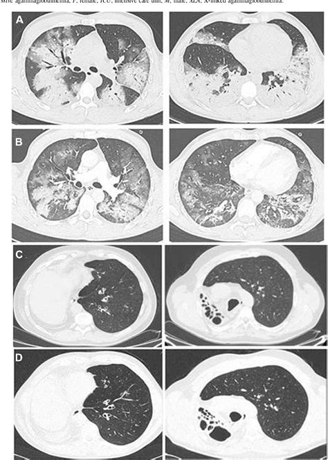 Figure 1 from A possible role for B cells in COVID-19? Lesson from patients with ...