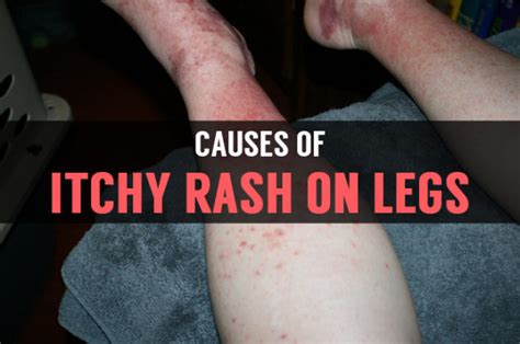 Itchy Rash on Legs - What Causes Rashes on Skin of Legs?