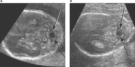 The Cisterna Magna Septa - Robinson - 2007 - Journal of Ultrasound in ...