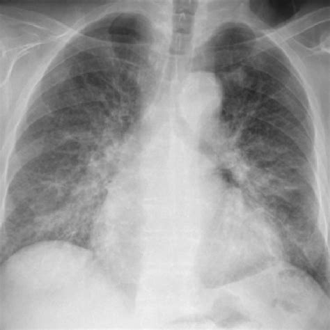 (PDF) AIRWAY DISEASES