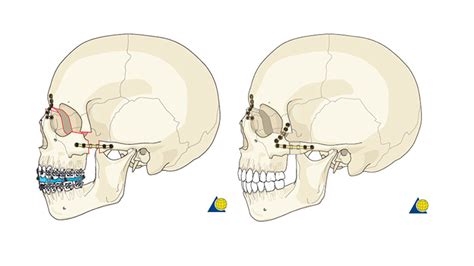 Surgical Management of Craniofacial Conditions | Children's Hospital of ...