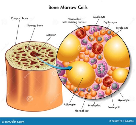 Bone Marrow Donation Medical Poster Info Graphic Cartoon Vector ...