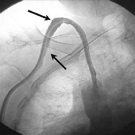 Partial dislocation of the catheter: the Dacron cuff just outside the ...