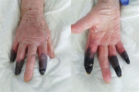 Bizarre COVID-19 symptoms mount: Gangrene, ulcers, rashes