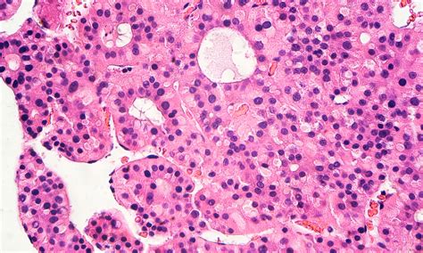 Australian recommendations for the management of hepatocellular carcinoma: a consensus statement ...