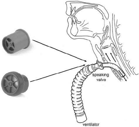 Tracheostomy Placement Diagram