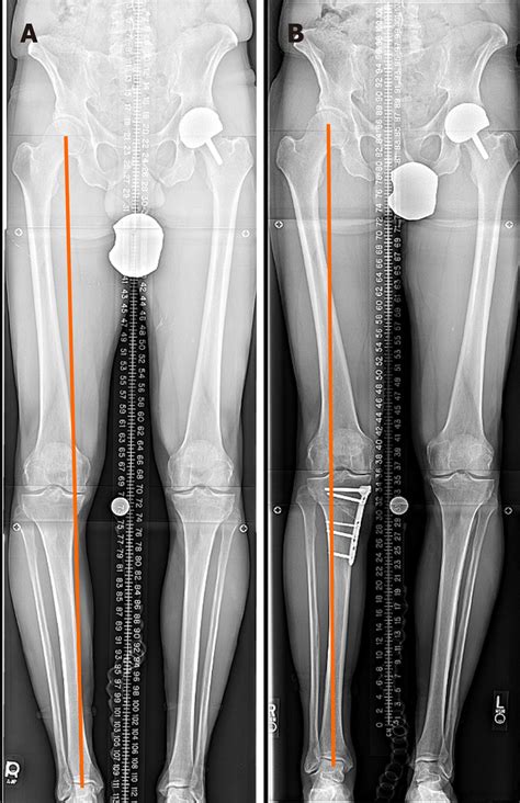 High tibial osteotomy with plate and screws. A: Pre-operation; B ...