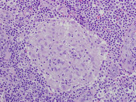 Pathology of Granulomatous Disease | Lungs