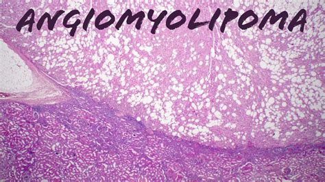 Angiomyolipoma of kidney (pathology histology PEComa tuberous sclerosis tumor usmle) - YouTube