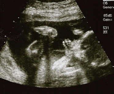 my dream on a budget: ultrasound: 2nd trimester